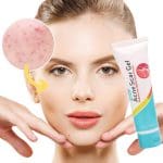Laoshi Acne scars gel 8