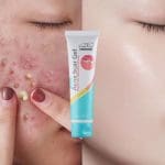 Laoshi Acne scars gel 8
