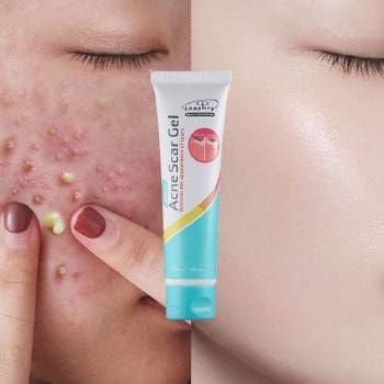 Laoshiya Acne Scar Gel Cream - 35ml