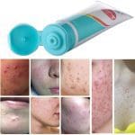 Laoshi Acne scars gel 8